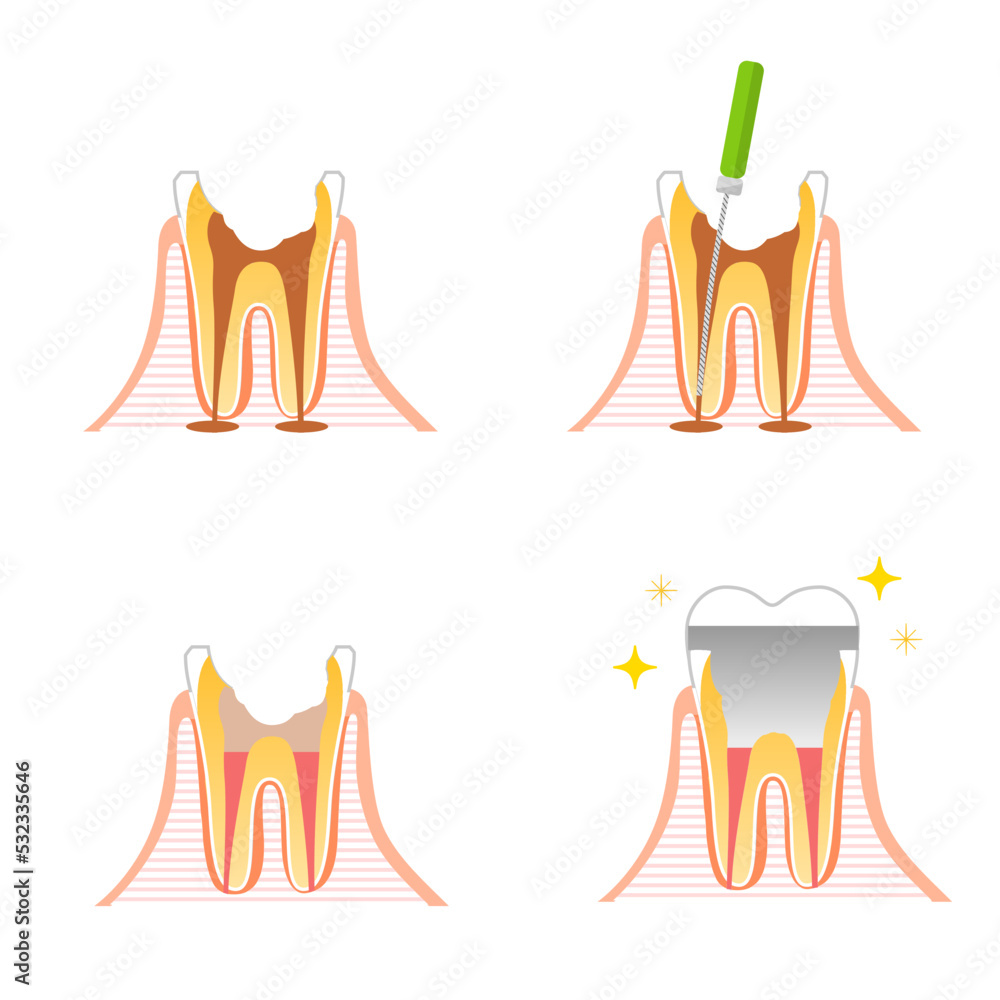 根管治療から被せ物（クラウン）までの流れ