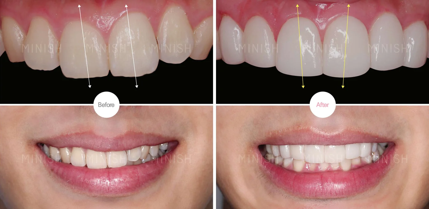 HIT式べニア（削らないべニア治療）