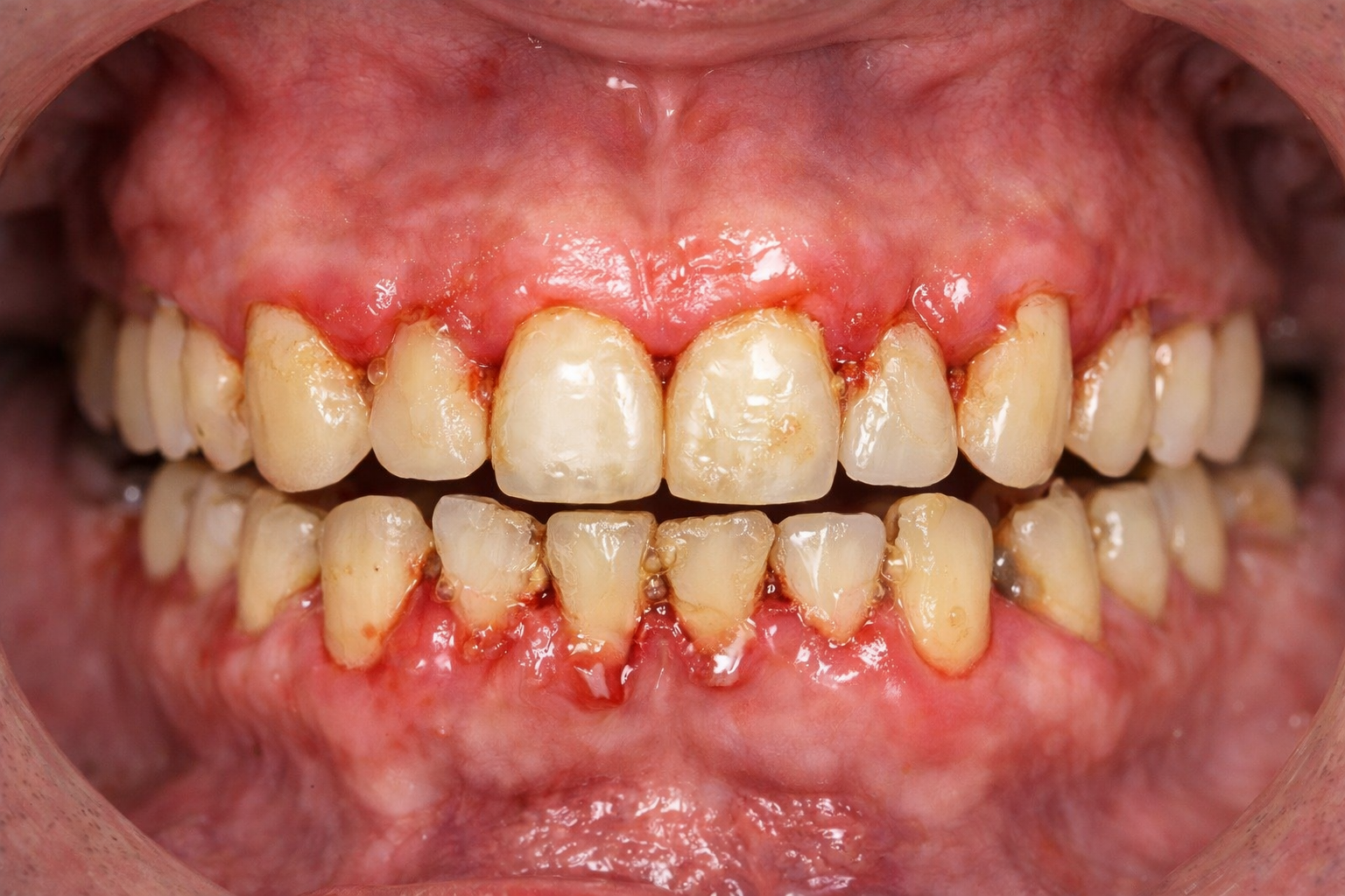 歯周病と関連する病気について