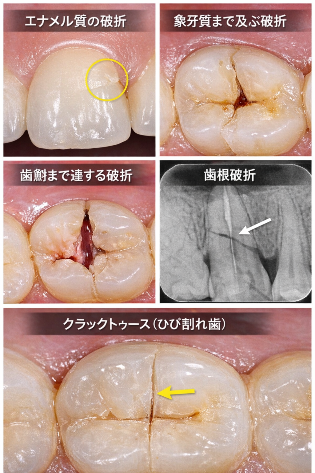 歯の破折、ひびが起こった時に考えること