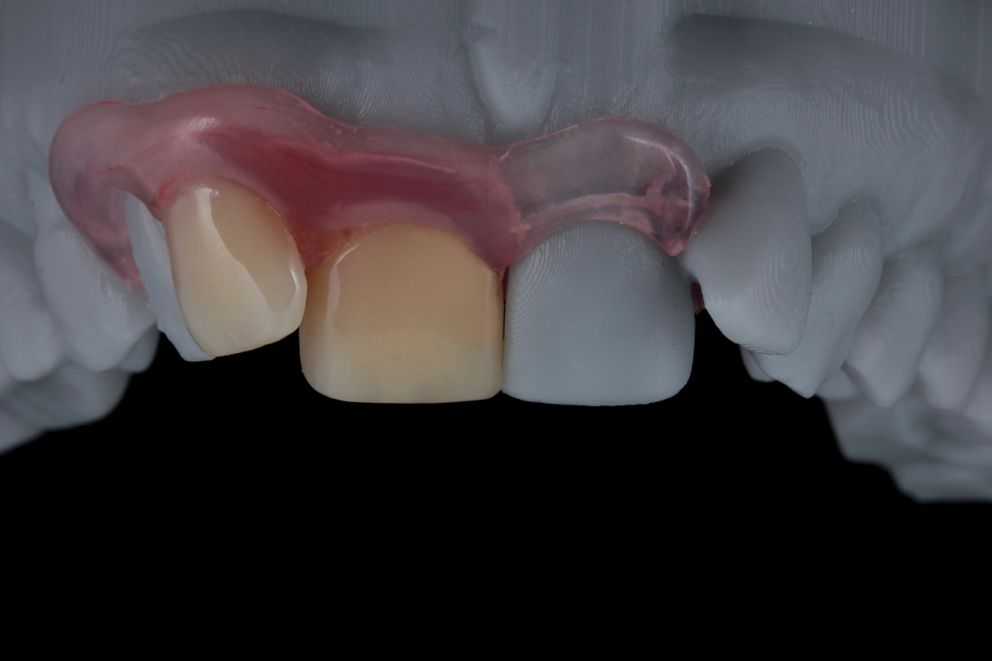ノンクラスプデンチャーについて