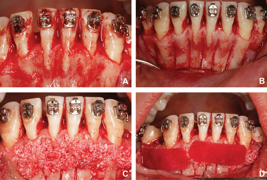 歯科矯正コルチコトミーについて