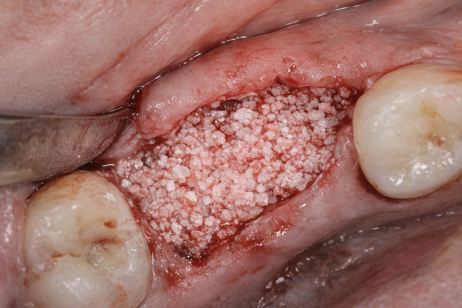 骨補填材について