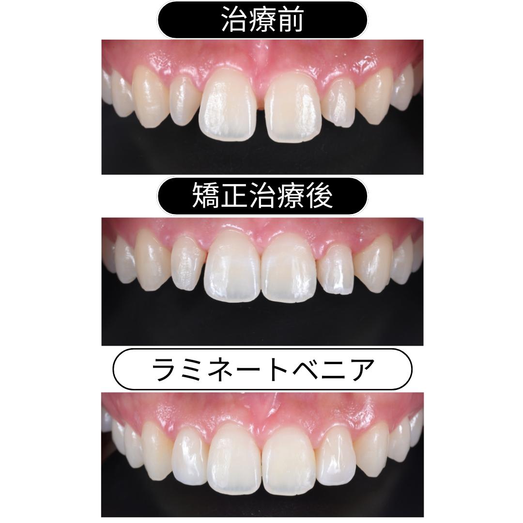 HIT式べニア（削らないべニア治療）