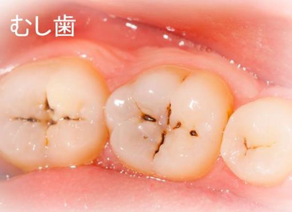 虫歯の進行と危険信号